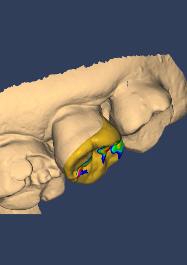 Diseño exocad - My Lab Dental
